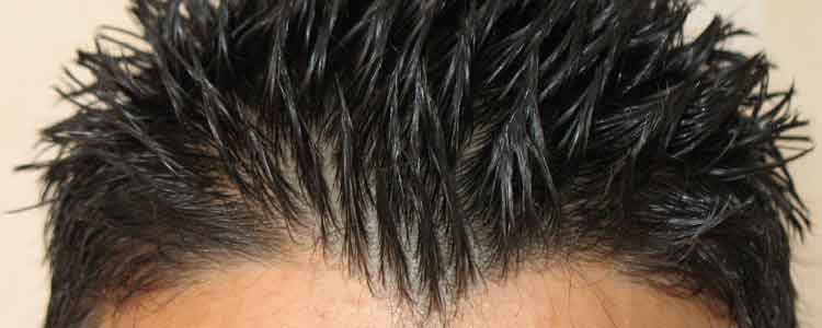 dandruff home remedies