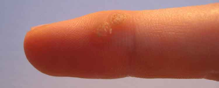 natural remedies for wart removal