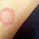 The 11 Best at Home Remedies for Ringworm