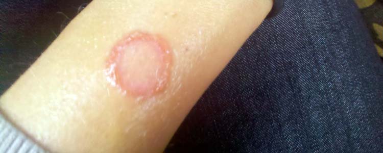 Ringworm Home Remedy