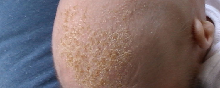 Cradle Cap