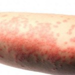 Natural Home Remedies for Eczema That Work