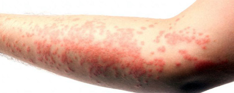 Eczema