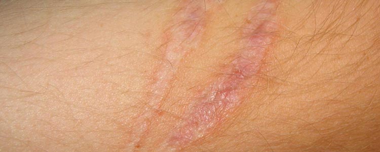 burn scar treatment home remedies