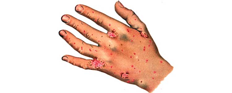 Hand With Scabies
