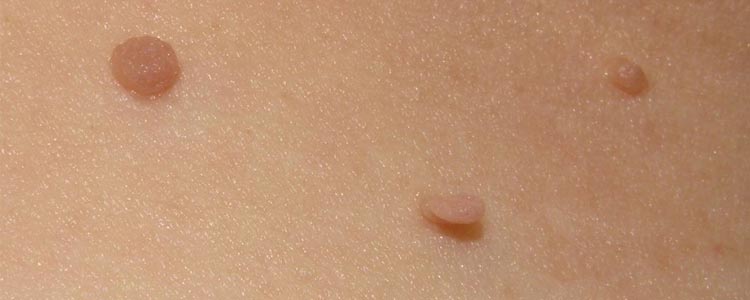Top 10 Home Remedies for Skin Tags