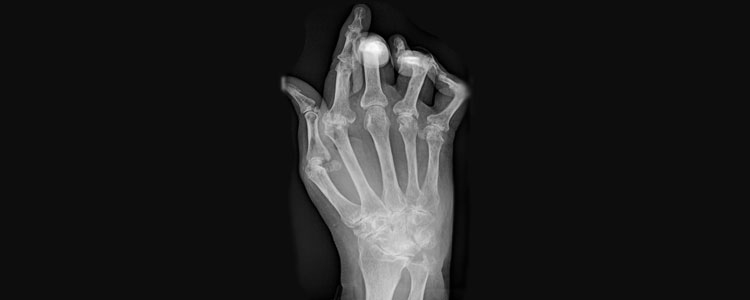 rheumatoid-arthritis-x-ray