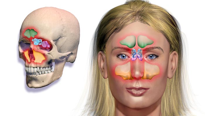 Sinusitis Nasal Polyps