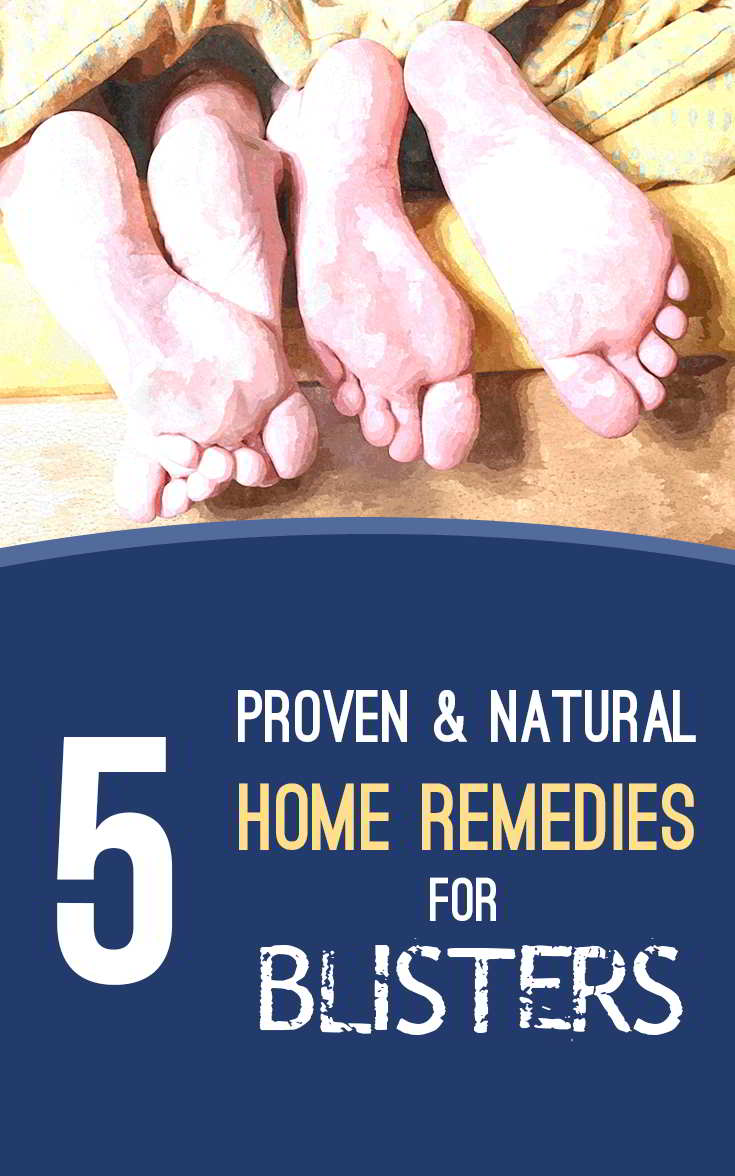 Soothe Blisters with these proven natural home remedies #homeremedies