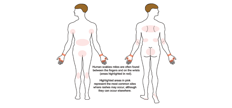Home Remedies for Scabies - What to Look For